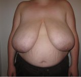 abelena.com_Pre-BR-Mandy-says she was a 38I and that nine pounds were subsequently removed.jpg
